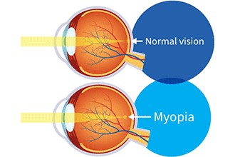 Myopia Callout 1